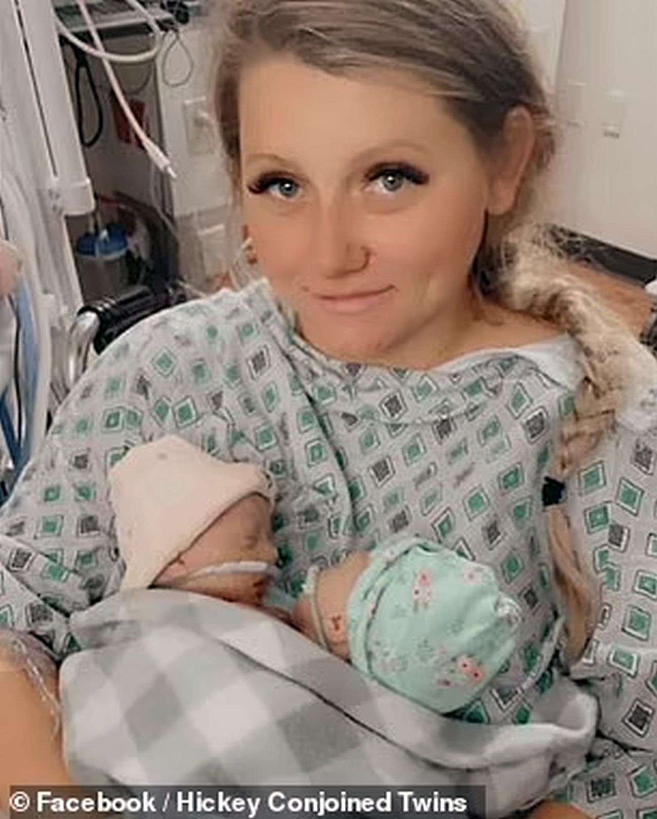 Mother holding her conjoined twins.